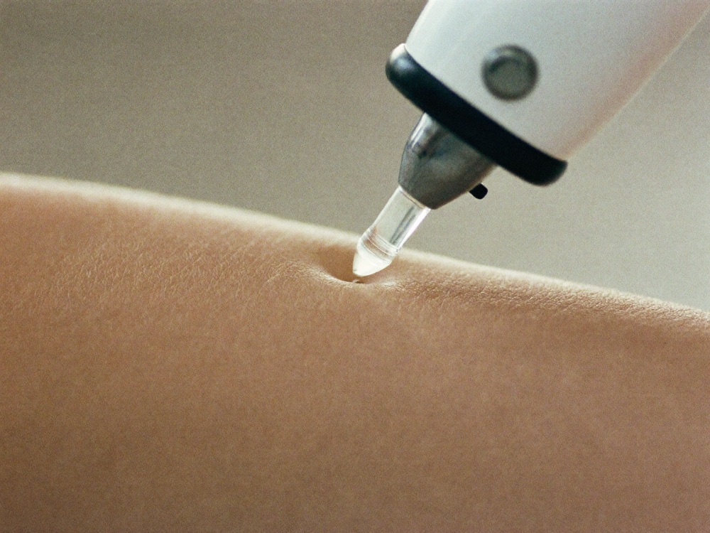 Macro detail of sapphire cooling tip contacting skin
